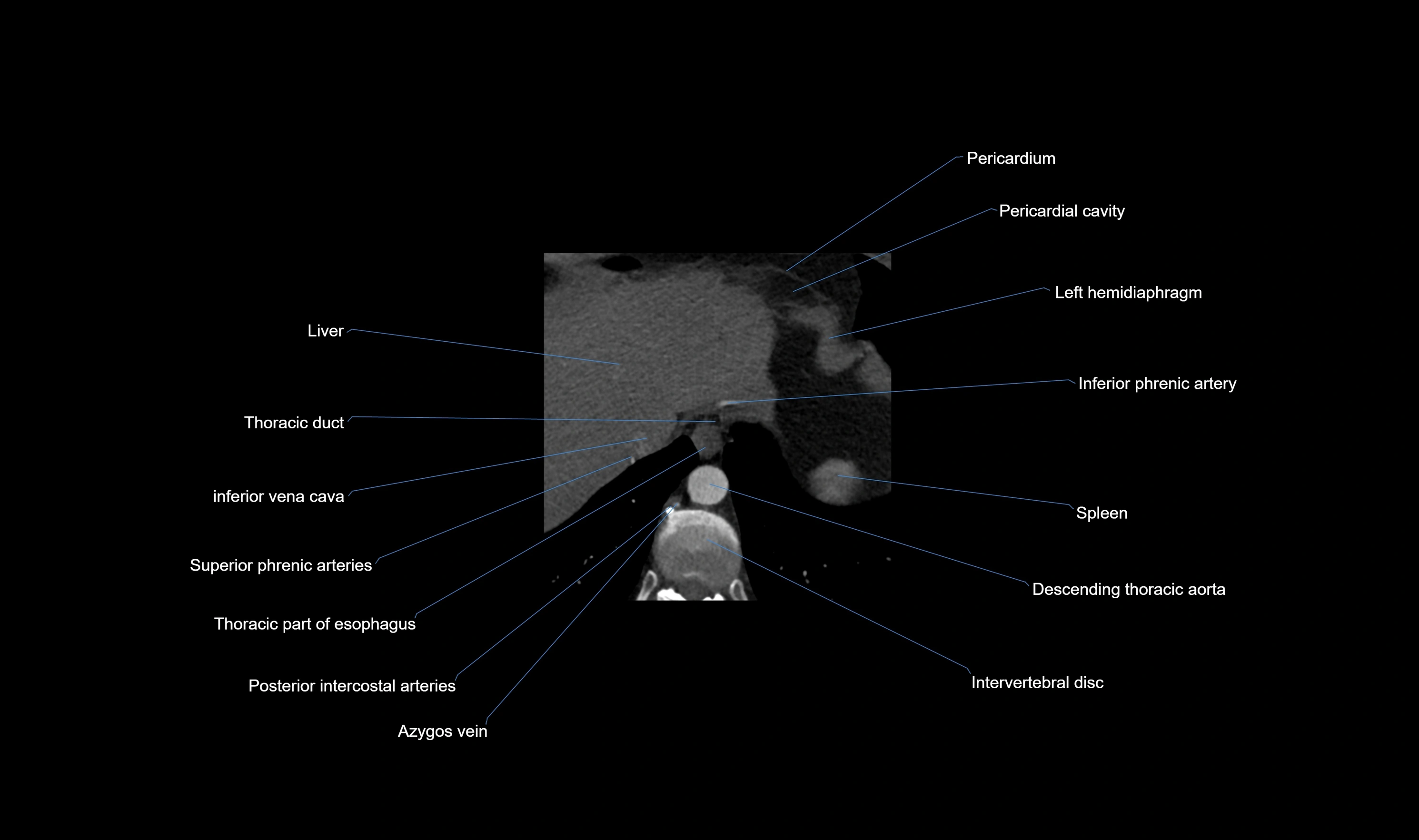 CT heart (coronary angiogram) axial view cross sectional anatomy labelled radiology image-00068.webp